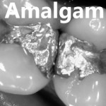 amalgam  fillings