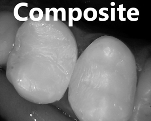 composite fillings